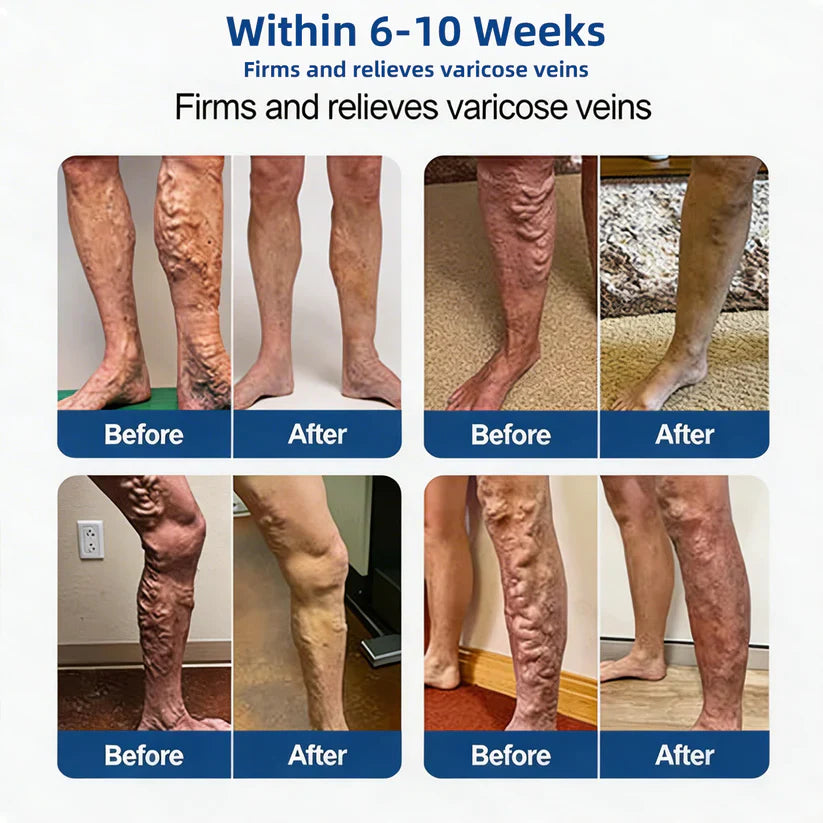 TAILEDEN® 𝑽𝗲𝗶𝙣 𝘾𝐨𝐧𝘁𝗼𝙪𝙧 𝙈𝙞𝐜𝐫𝒐𝒏𝒆𝗲𝗱𝗹𝙚 𝙋𝙖𝐭𝐜𝒉 𝒘𝒊𝘁𝗵 𝗔𝙙𝙫𝙖𝙣𝙘𝐞𝐝 𝐃𝒊𝒐𝒔𝗺𝙞𝐧 & 𝑯𝒆𝘀𝗽𝗲𝙧𝙞𝙙𝙞𝐧 𝐃𝒆𝒍𝒊𝒗𝗲𝗿𝙮🌿𝟕-𝐃𝐚𝐲 𝐕𝐢𝐬𝐢𝐛𝐥𝐞 𝐑𝐞𝐬𝐮𝐥𝐭𝐬 𝐟𝐨𝐫 𝐕𝐚𝐫𝐢𝐜𝐨𝐬𝐞 𝐕𝐞𝐢𝐧𝐬